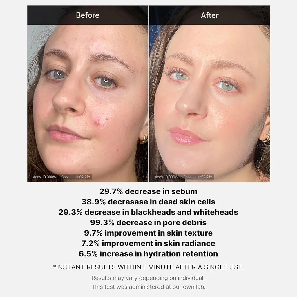 Medicube Red Acne Succinic Acid Peel 40 g